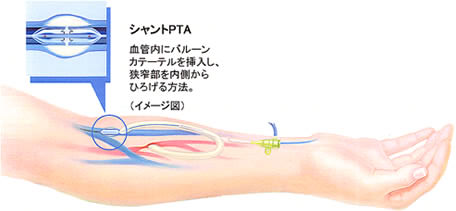 シャントPTAのイラスト　血管内にバルーンカテーテルを挿入し、狭窄部を内側からひろげる方法。